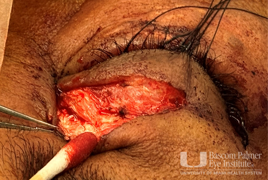 Chronic orbital inflammation secondary to paint injury