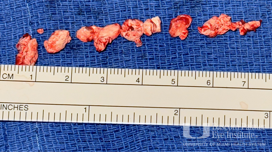 Chronic orbital inflammation secondary to paint injury
