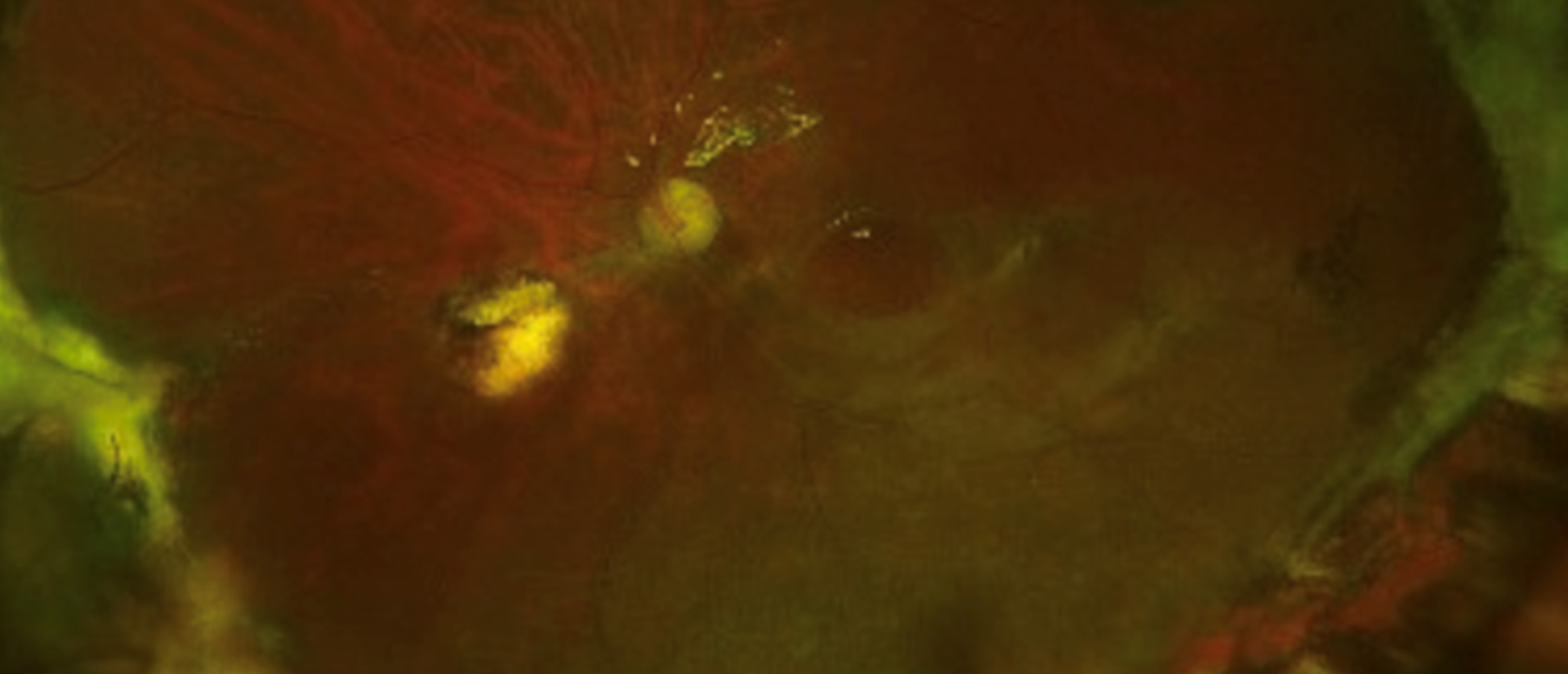 Recurrent Rhegmatogenous Retinal Retachment with Recurrent Giant Full Thickness Macular Hole