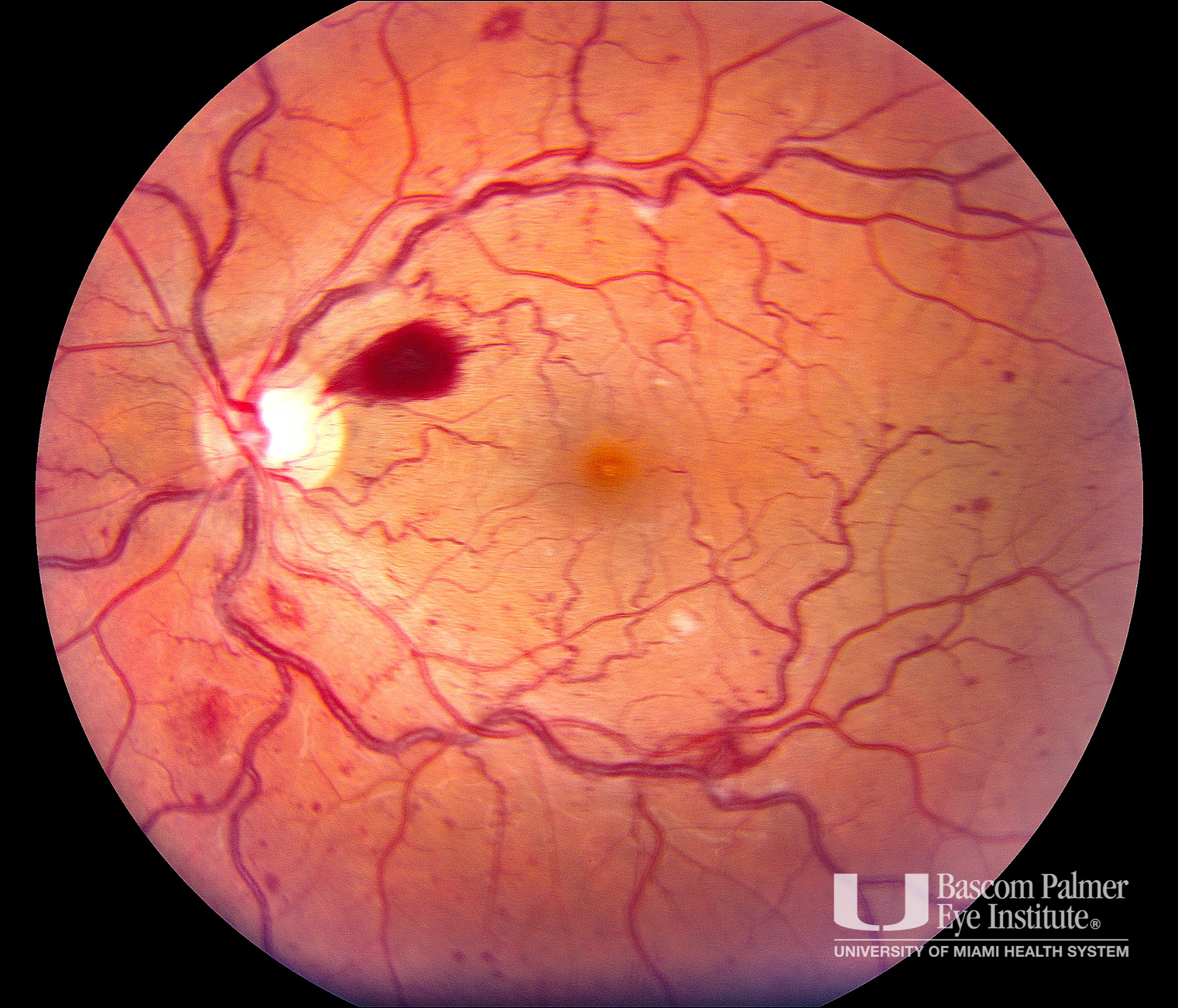 Carotid Cavernous Fistula with Ocular Ischemic Syndrome