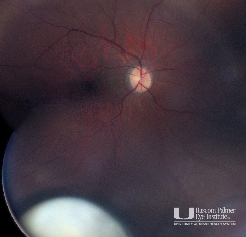 Dislocated White Cataract Mimicking Tumor