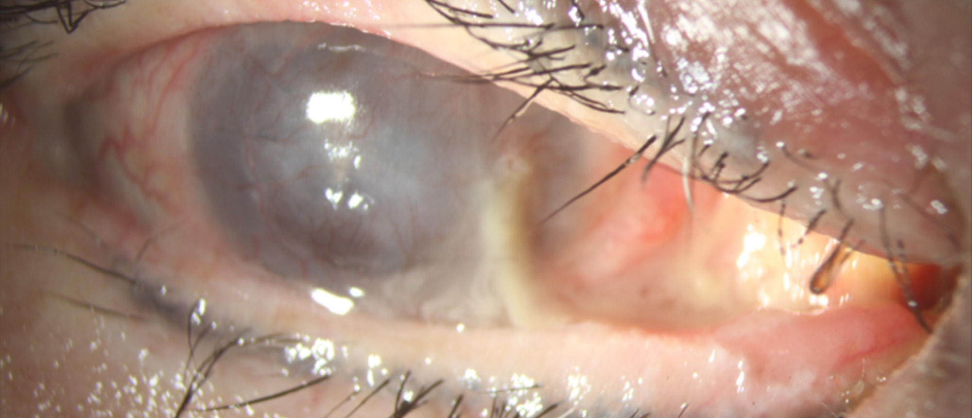 HPV-Positive Squamous Cell Carcinoma of the Conjunctiva and Lacrimal Sac