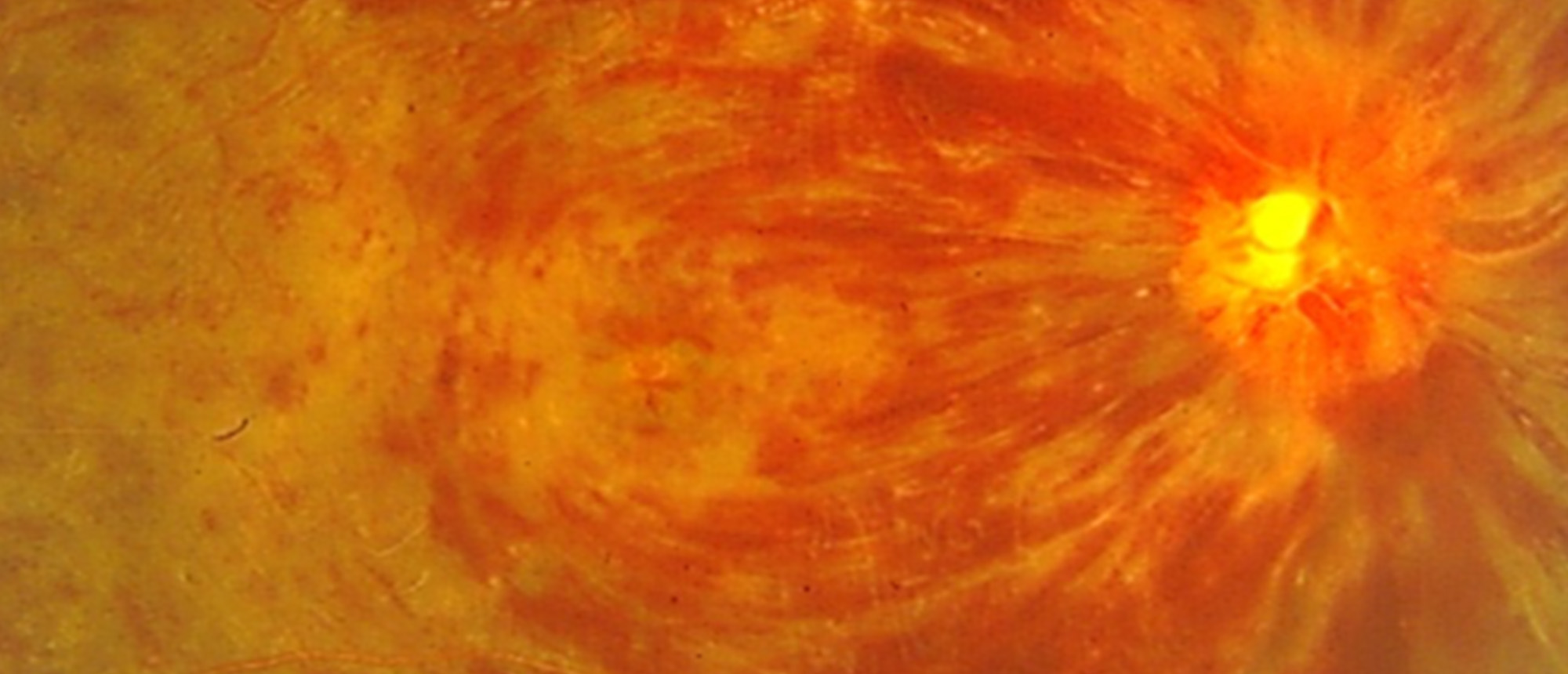 Leukemic Retinopathy 