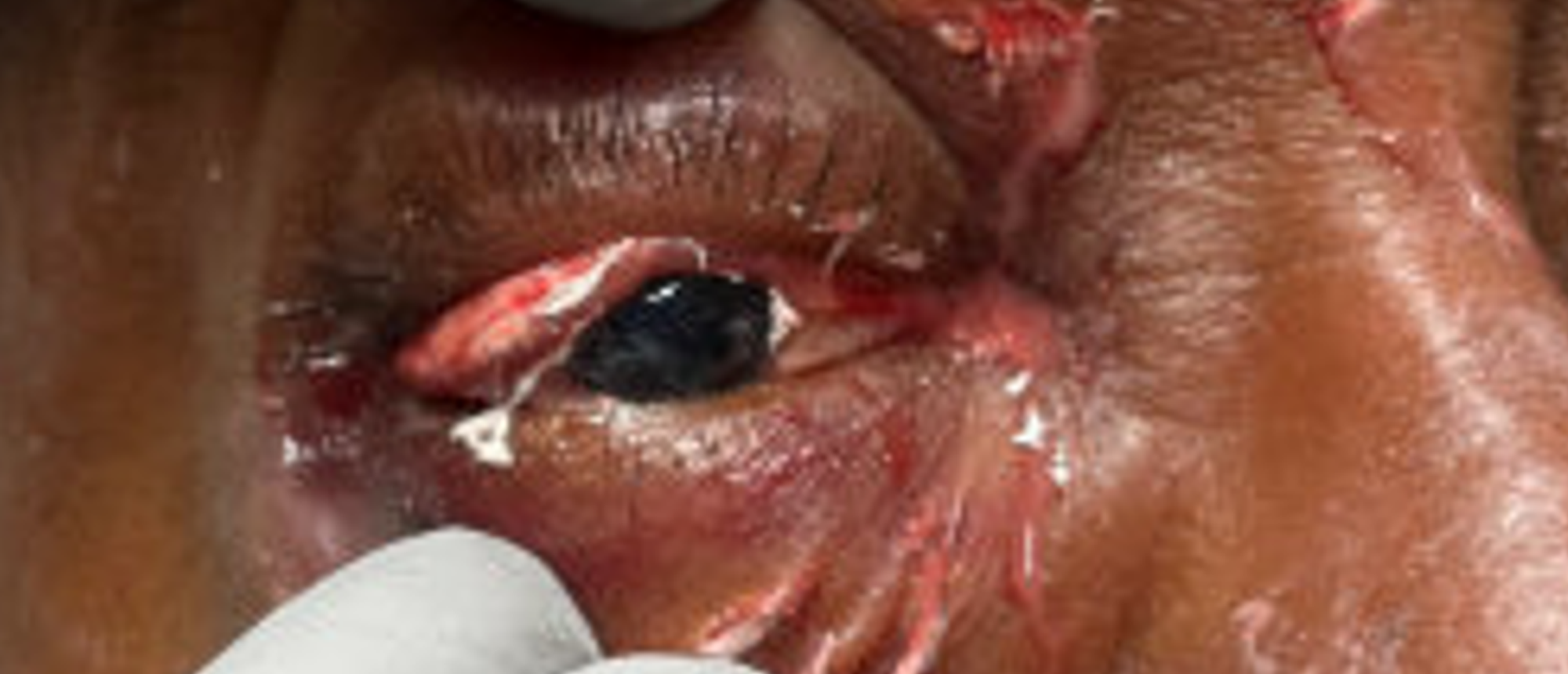 Copy of Chronic Orbital Inflammation Secondary to Paint Injury copy 1