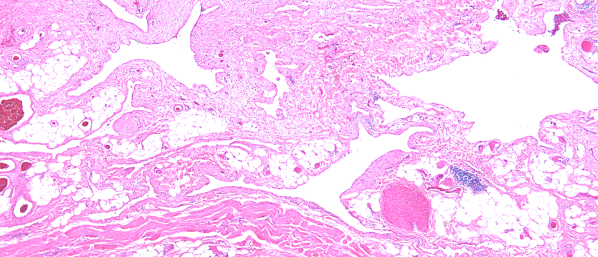 Capillary Malformation
