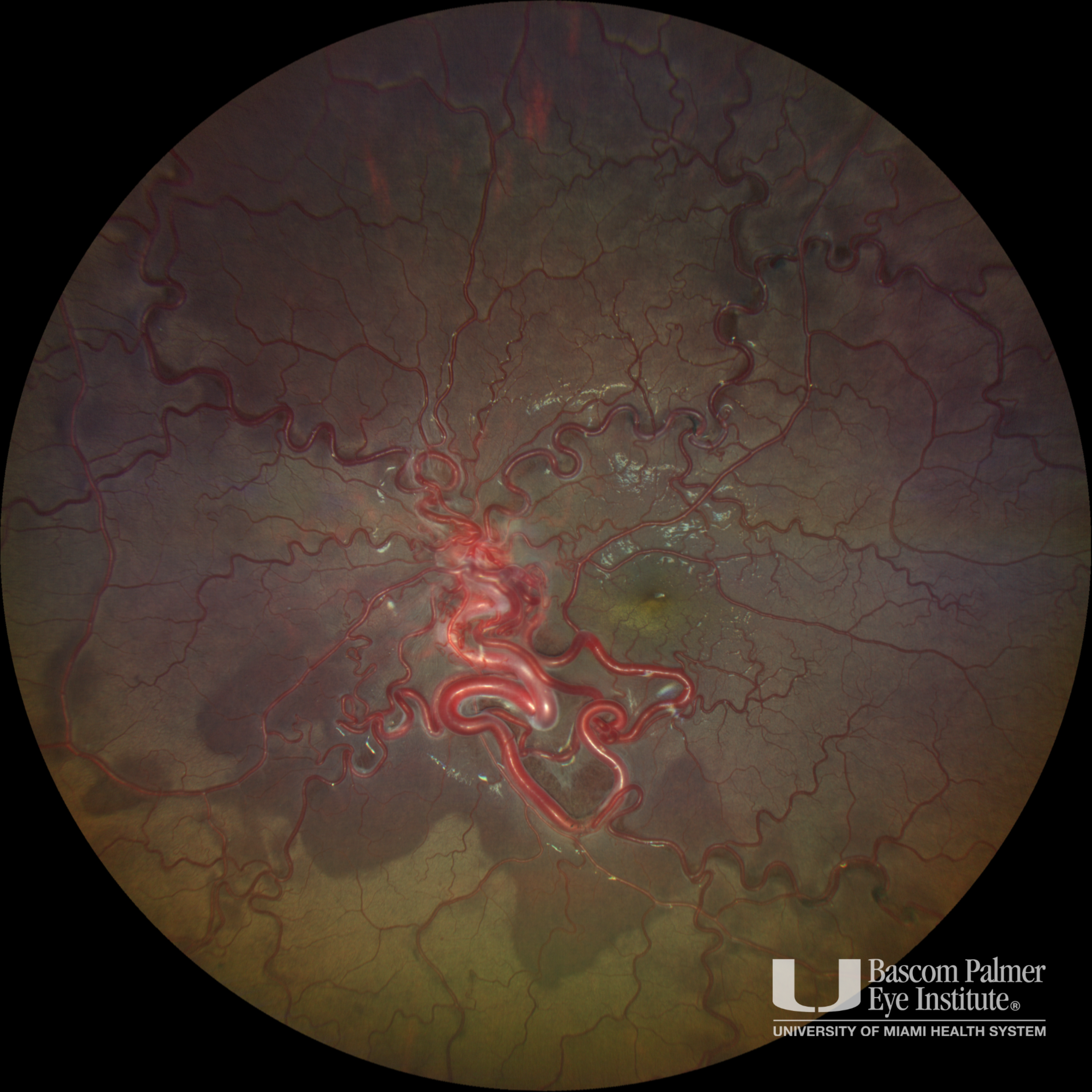 Wyburn-Mason Syndrome