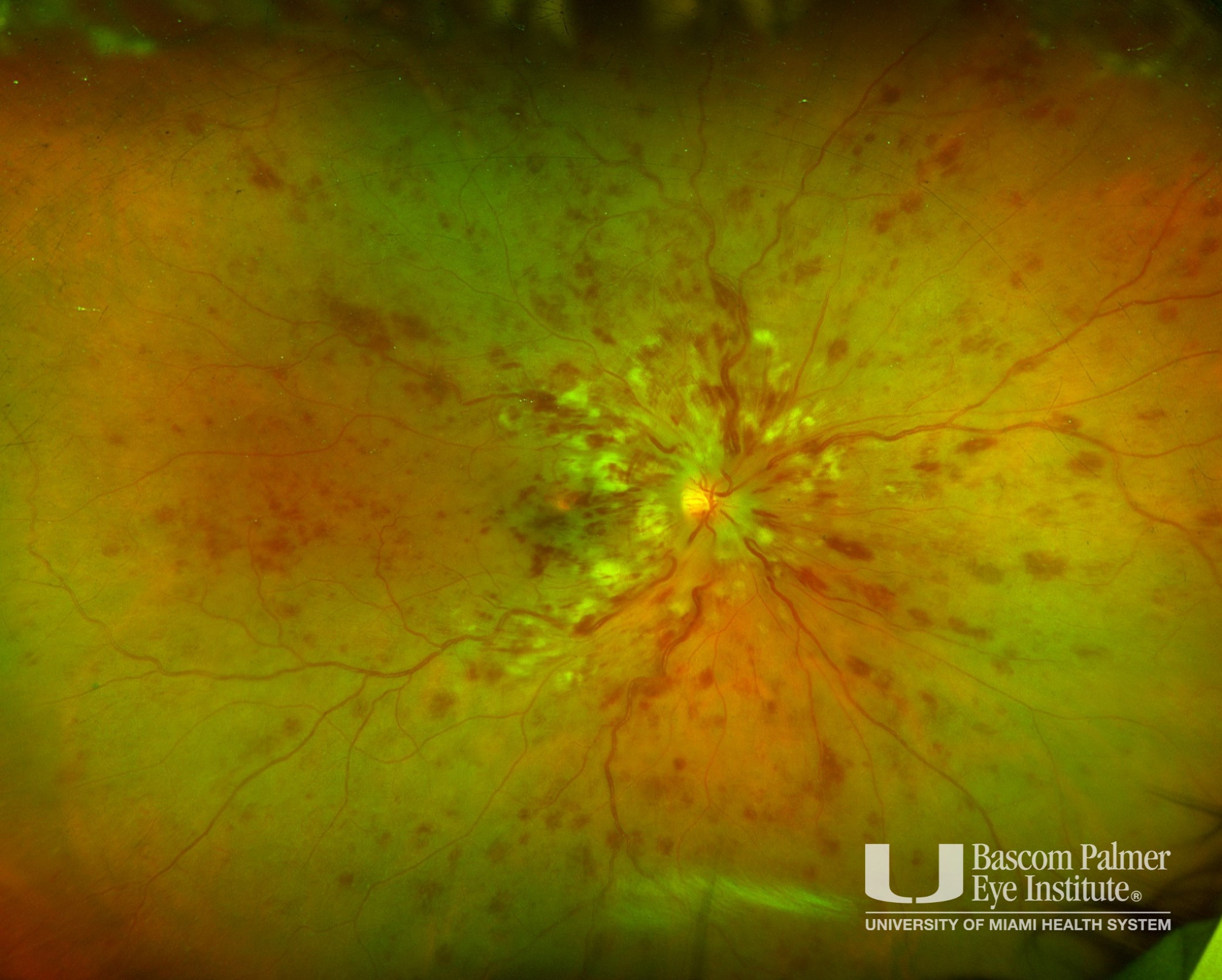Central Retinal Vein Occlusion Associated with Cocaine Abuse