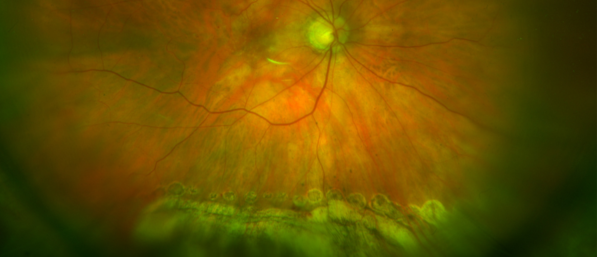 Retinal Displacement After Retinal Detachment Repair