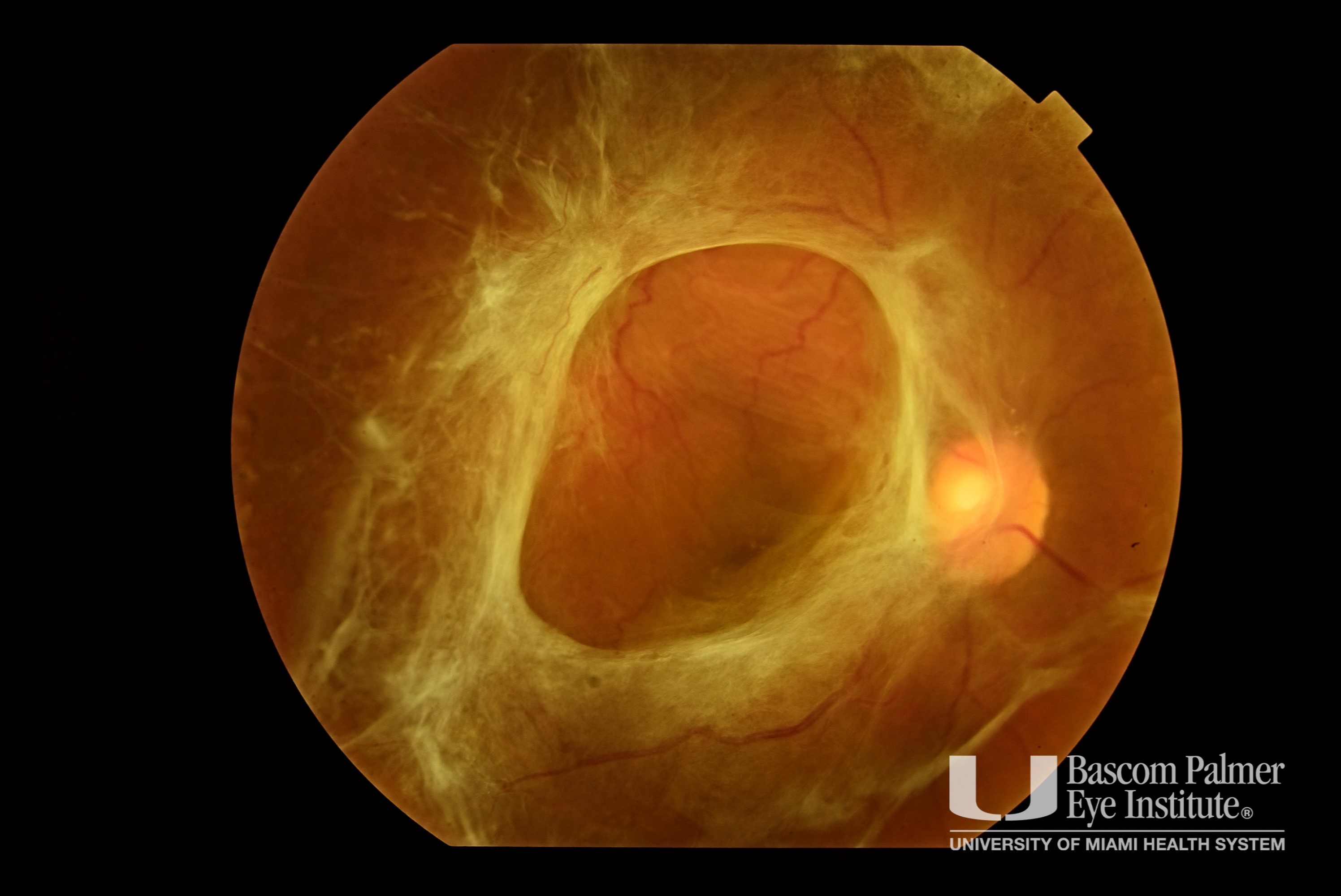 Tractional Retinal Detachment From Proliferative Diabetic Retinopathy