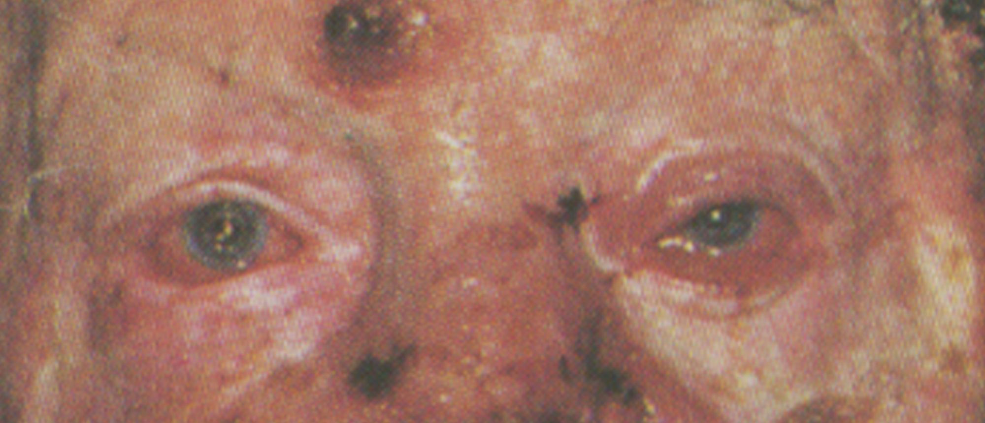 Nevoid Basal Cell Carcinoma