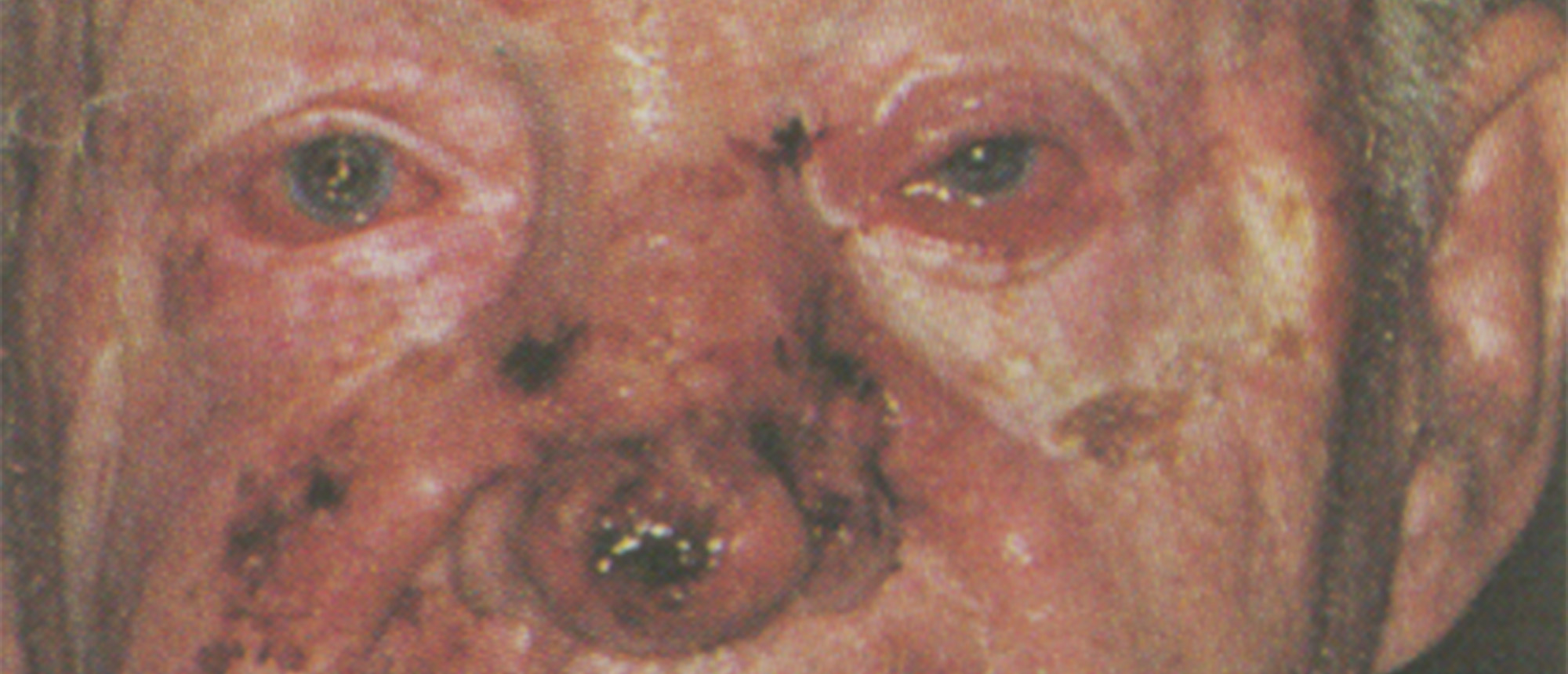 Nevoid Basal Cell Carcinoma