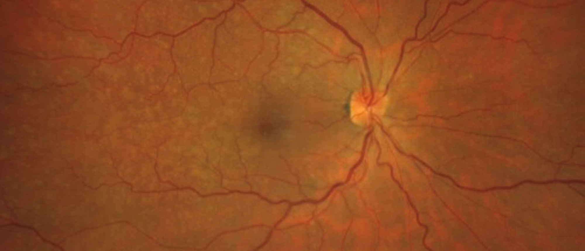 Primary Vitreoretinal Lymphoma 