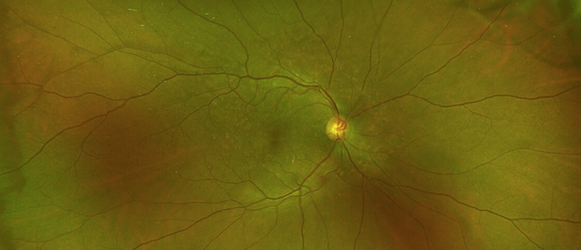 Drusen-Associated with Membranous Nephropathy 