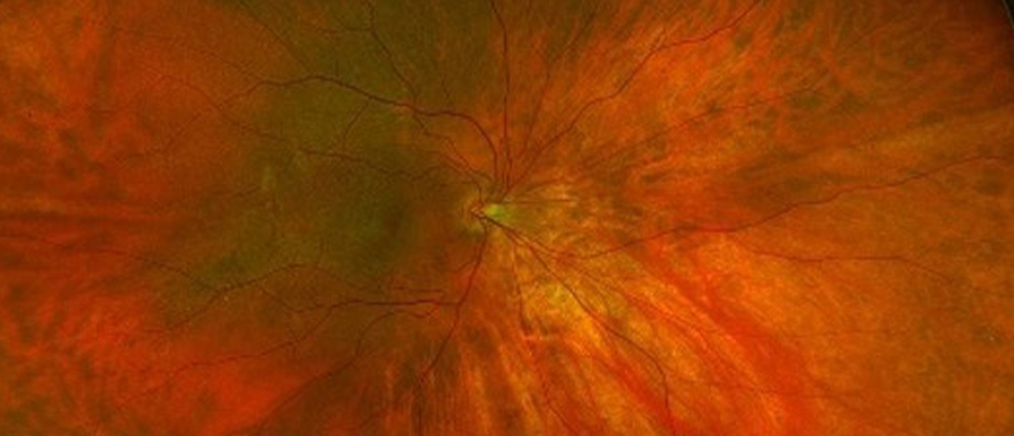 Dome-Shaped Maculopathy
