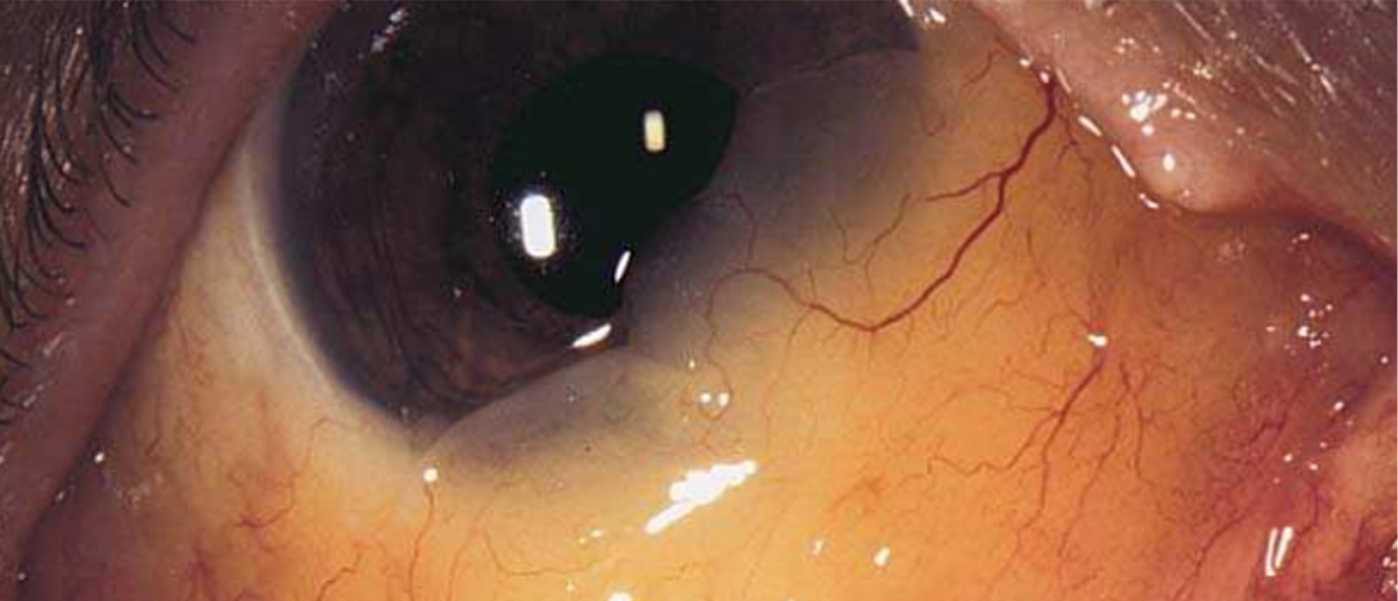 Conjunctival Amyloidosis 