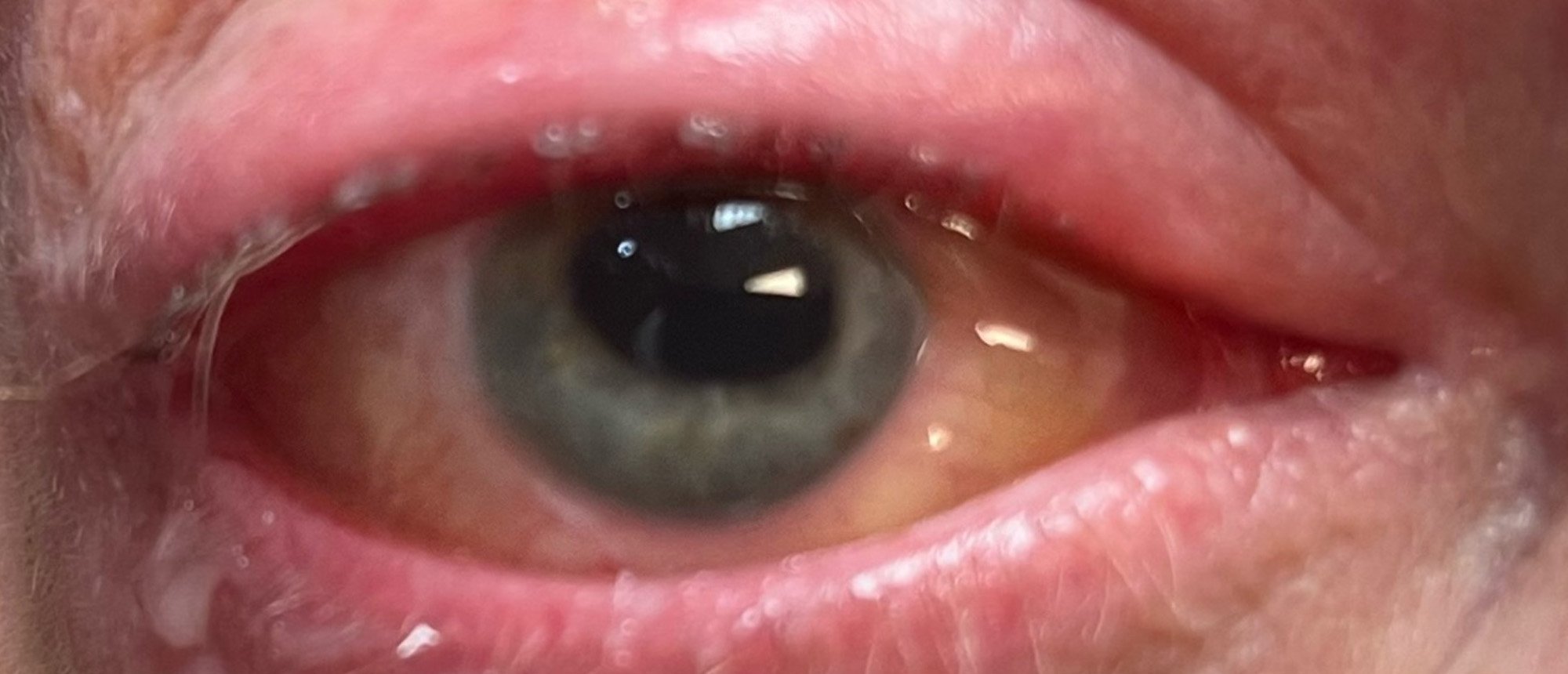 Choroidal Melanoma Complicated by Scleritis