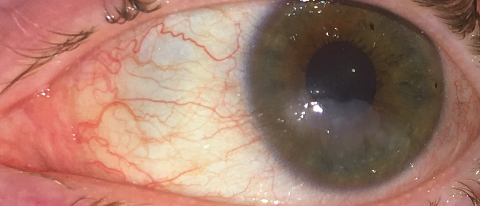 Familial Dysautonomia