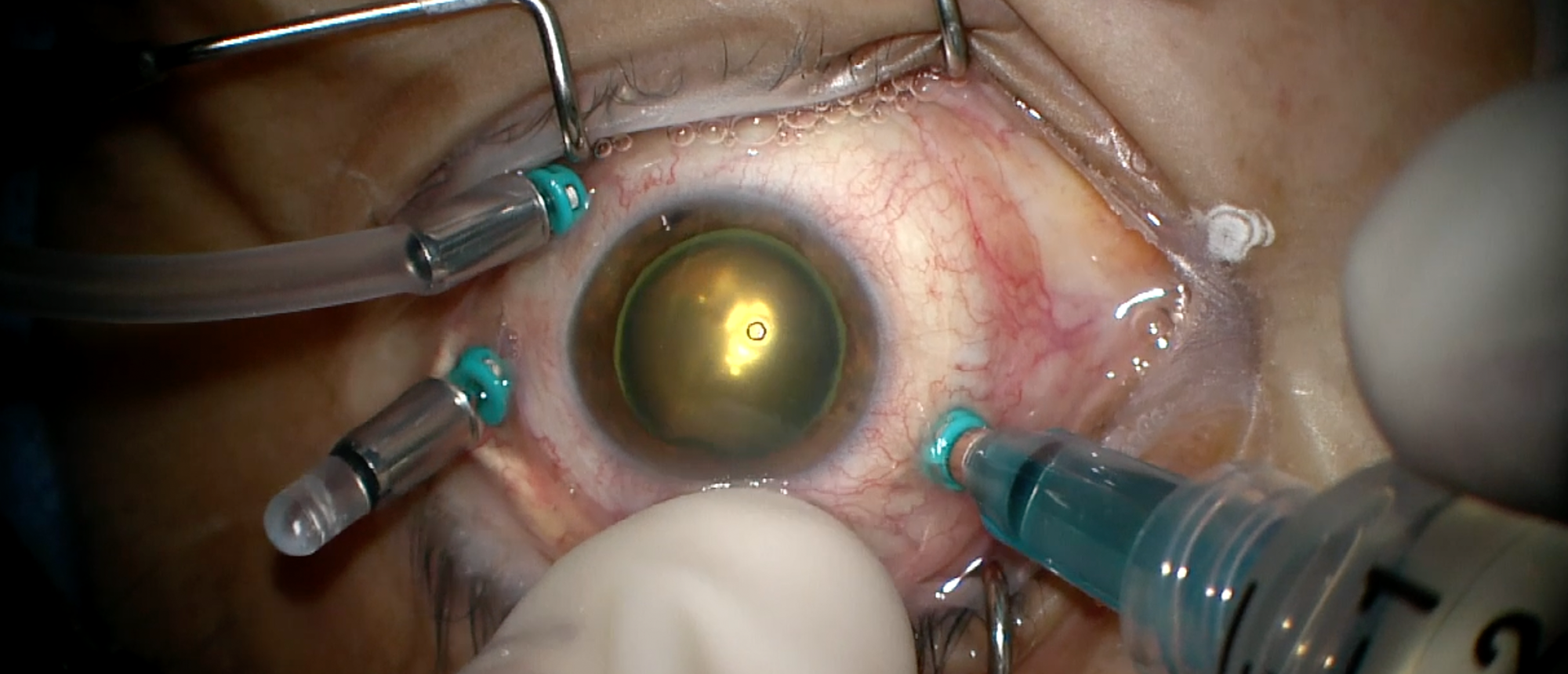 Retina Detachment Repair in Acute Retinal Necrosis Related Retinal Detachment