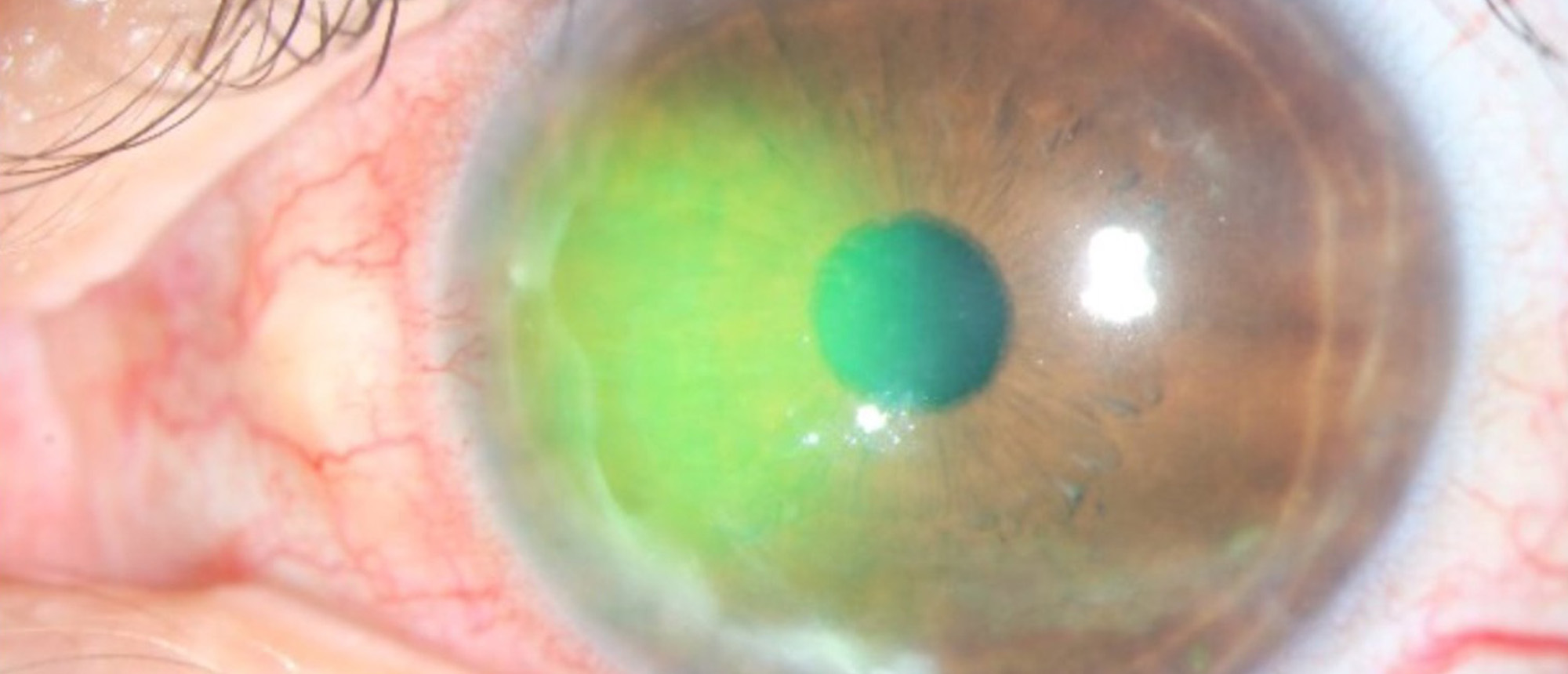 Neurotrophic Keratopathy 