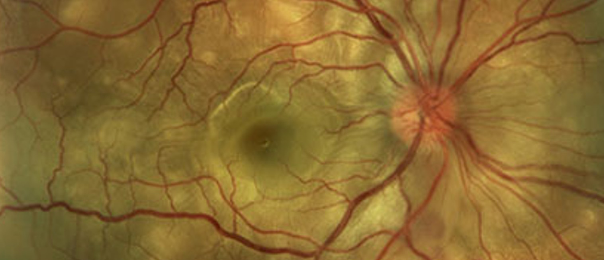 Sympathetic Ophthalmia