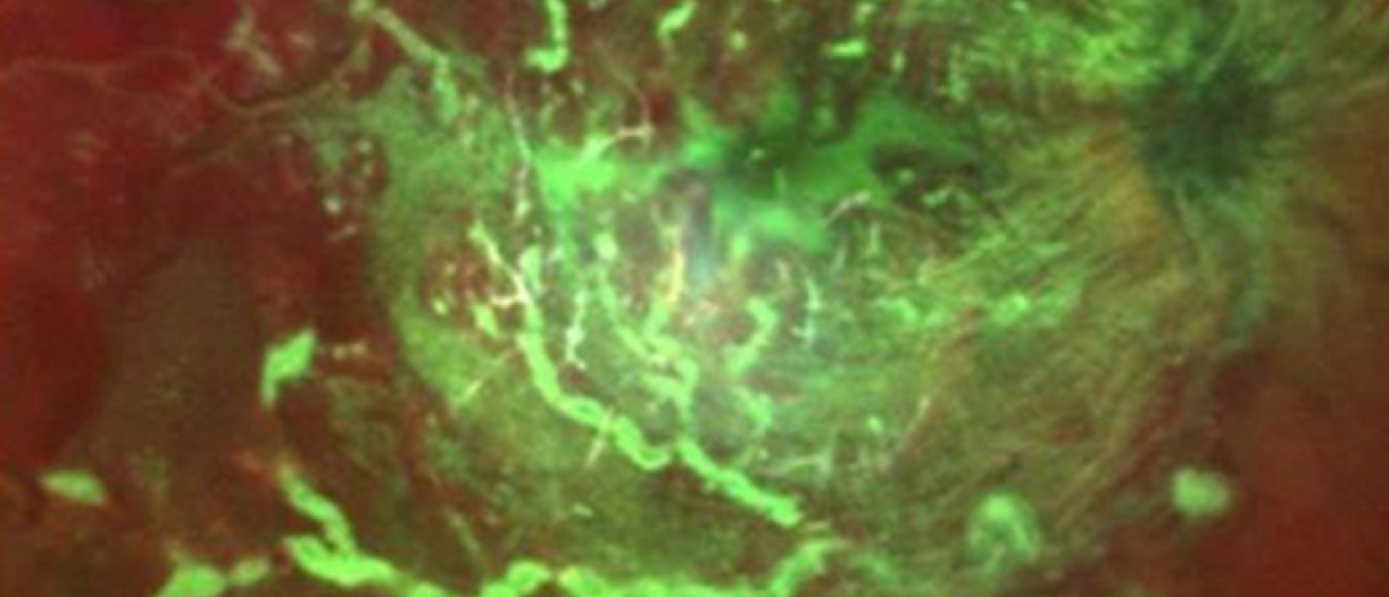 Purtscher's Like Retinopathy vs Vasculitis Consist with Familial Mediterranean Fever