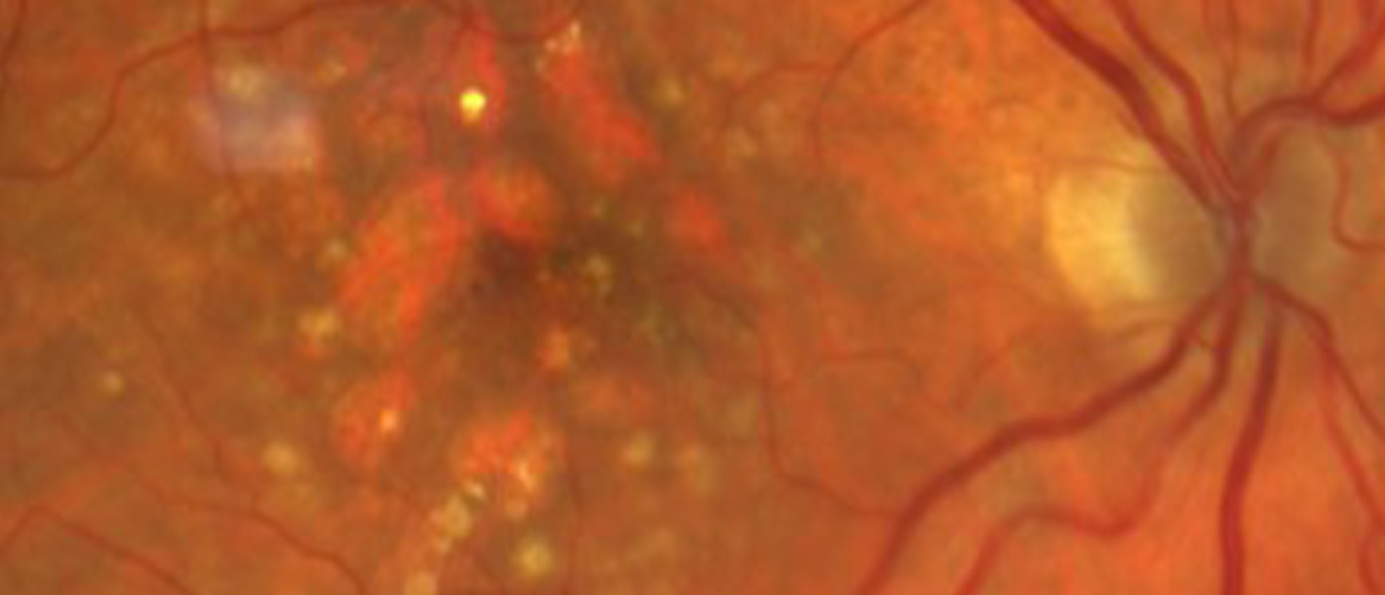 Pegcetacoplan Therapy Induced Optic Nerve Head Edema