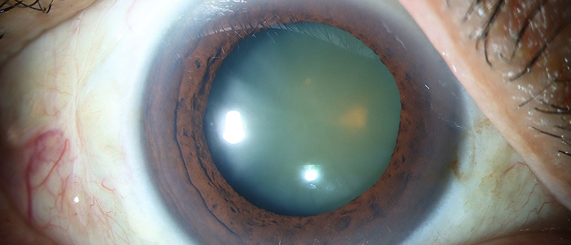 Long Anterior Zonules  