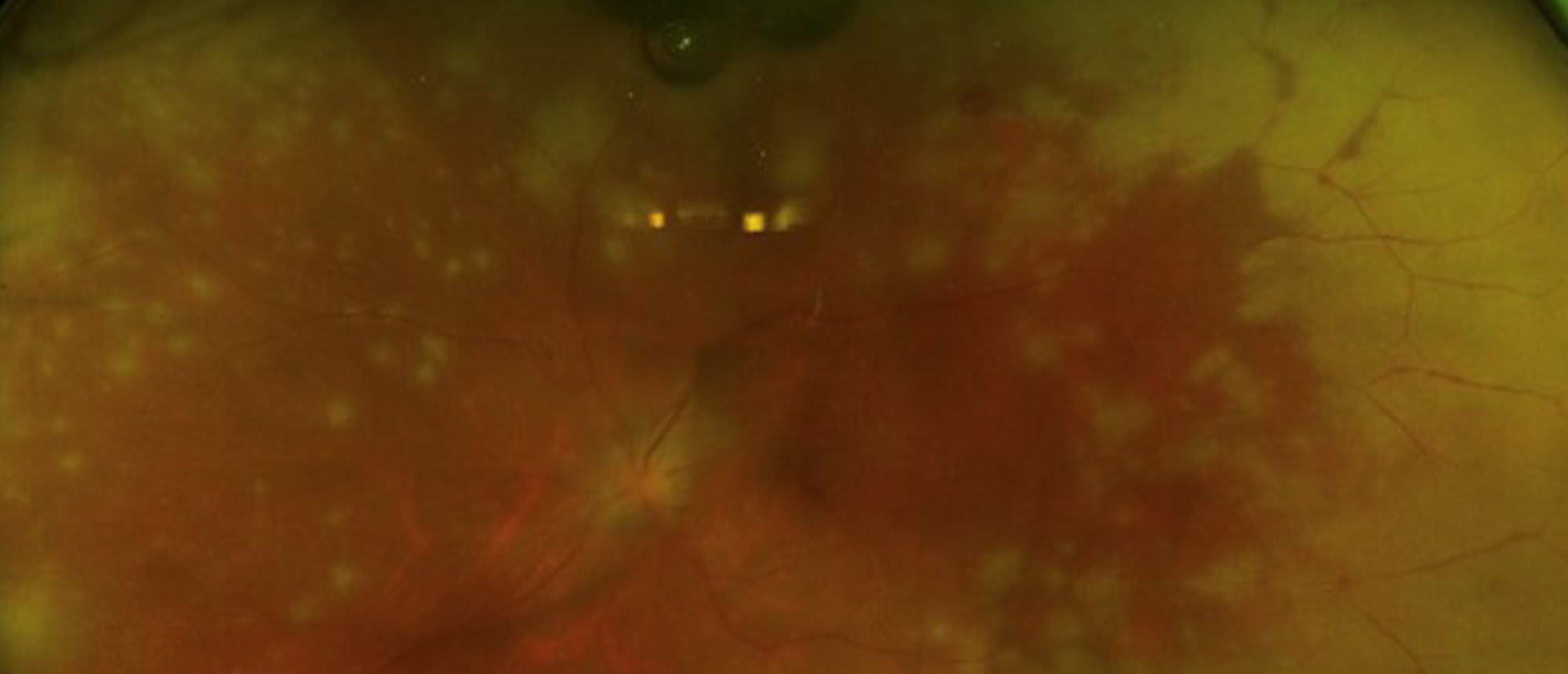Acute Retinal Necrosis (ARN) Due to Varicella Zoster Virus (VZV)