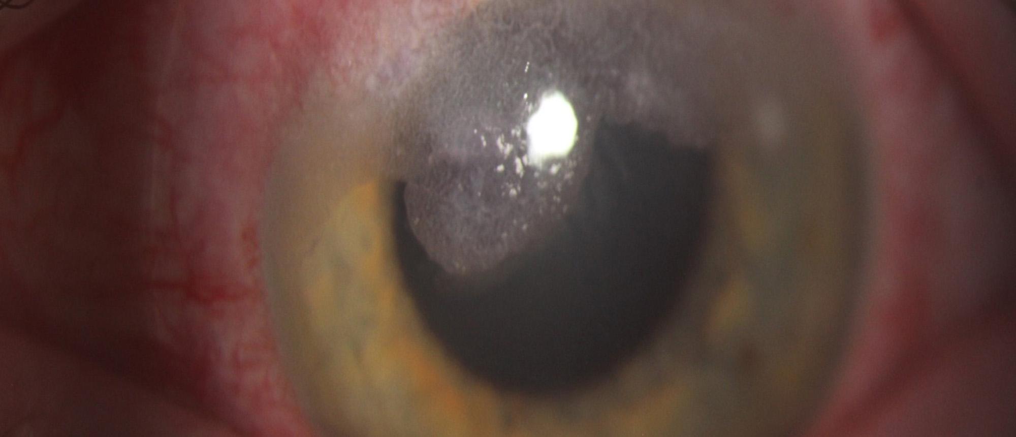 Terrien's Marginal Degeneration