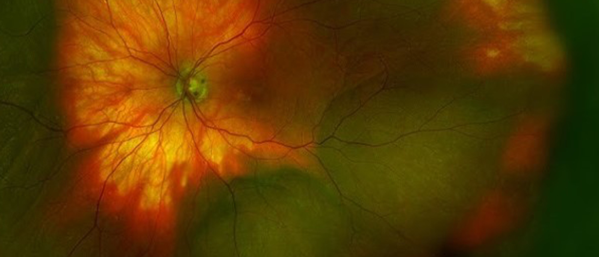 Spontaneous Suprachoroidal Hemorrhage