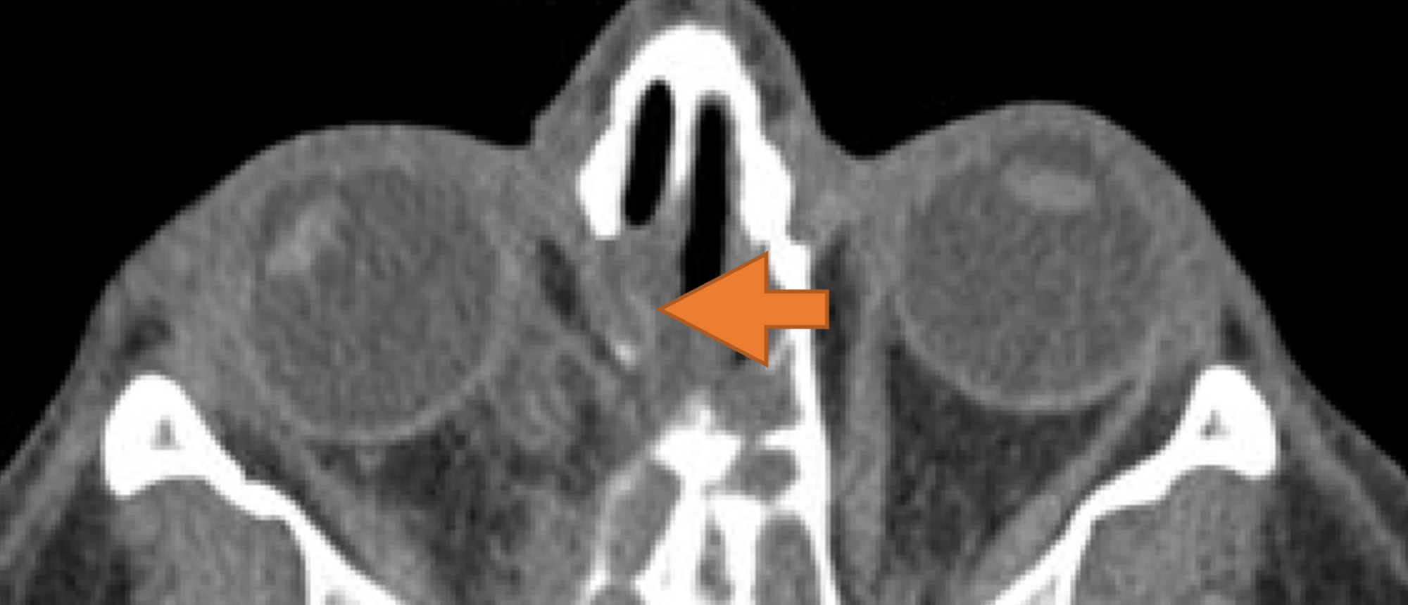 Paralytic and Restrictive Medial Rectus Dysfunction Secondary to Cocaine-Induced Midline Destructive Lesions