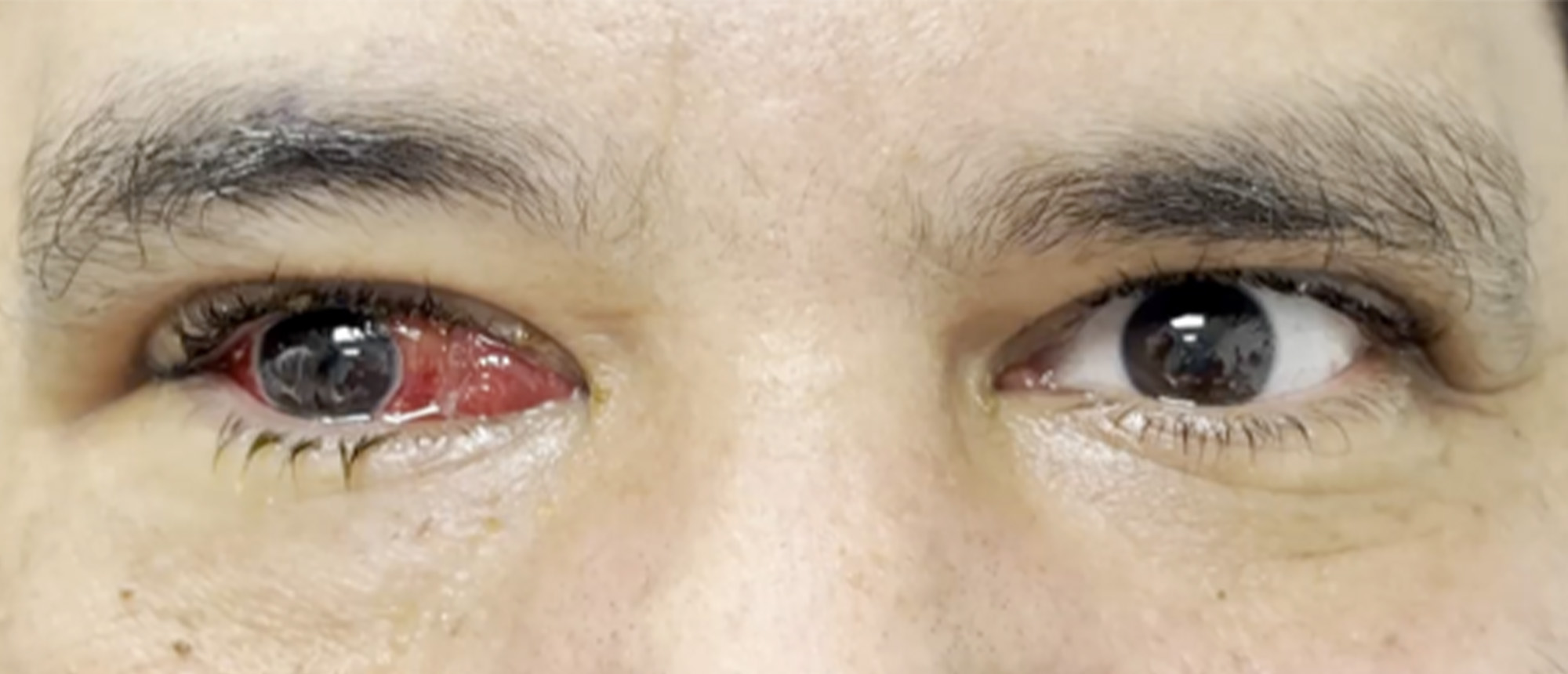 Paralytic and Restrictive Medial Rectus Dysfunction Secondary to Cocaine-Induced Midline Destructive Lesions