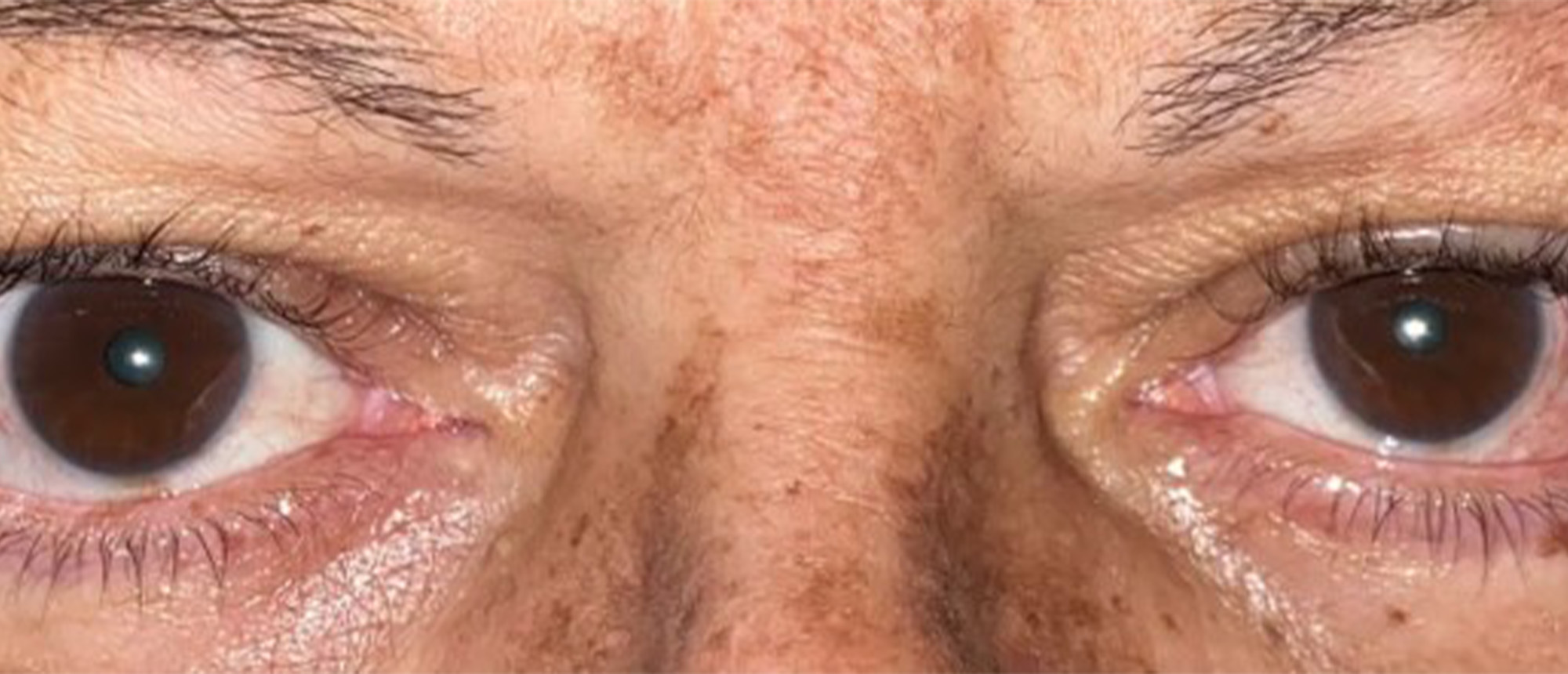 Partial Left VI Nerve Palsy