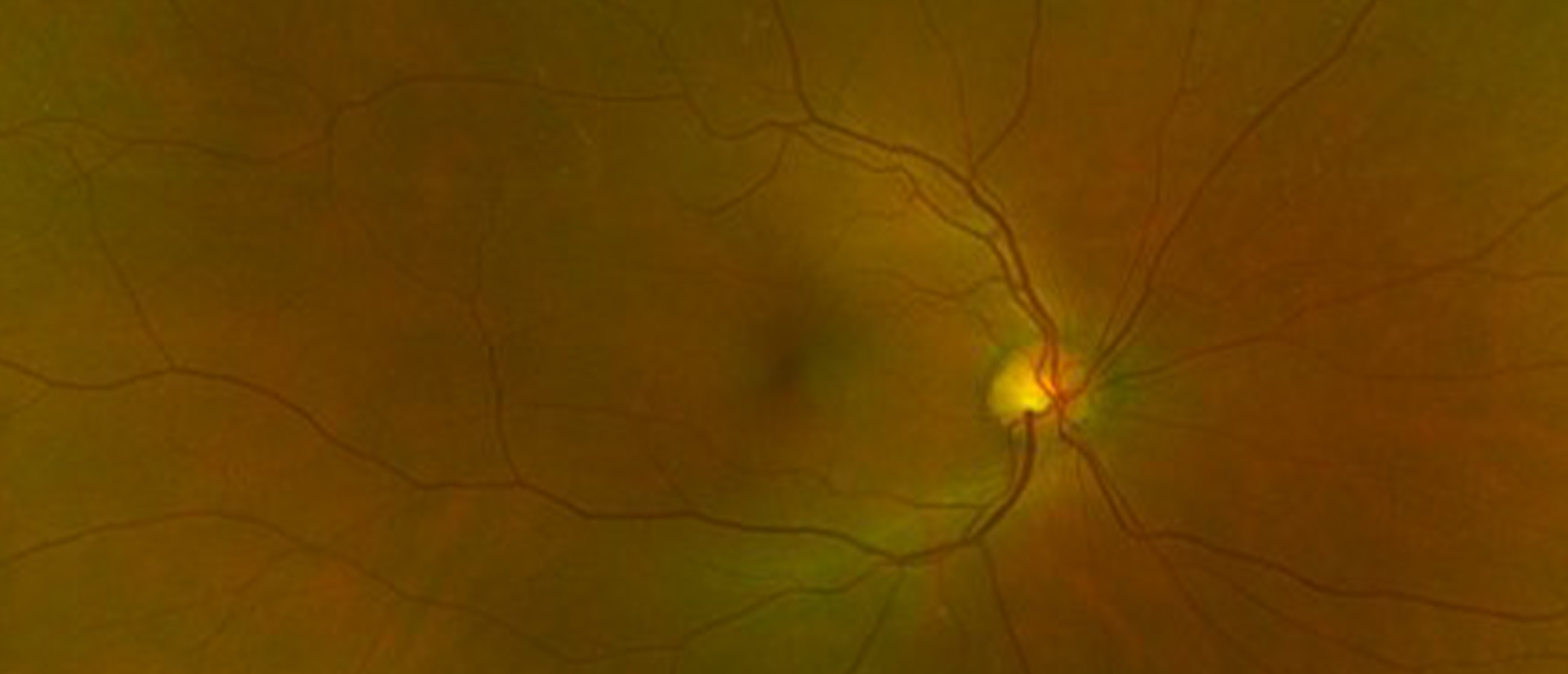 Central Serous Chorioretinopathy