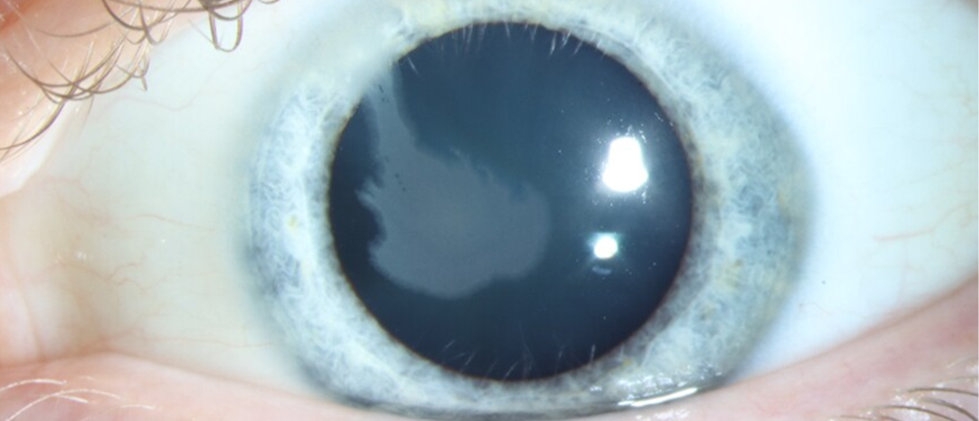 Lisch Epithelial Corneal Dystrophy