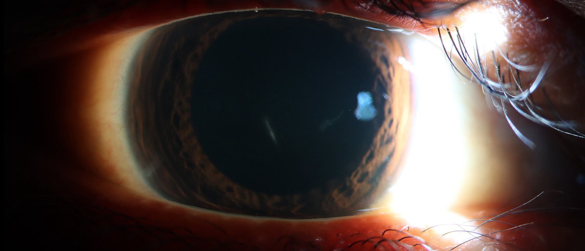 Suspected Early Traumatic Exogenous Endophthalmitis