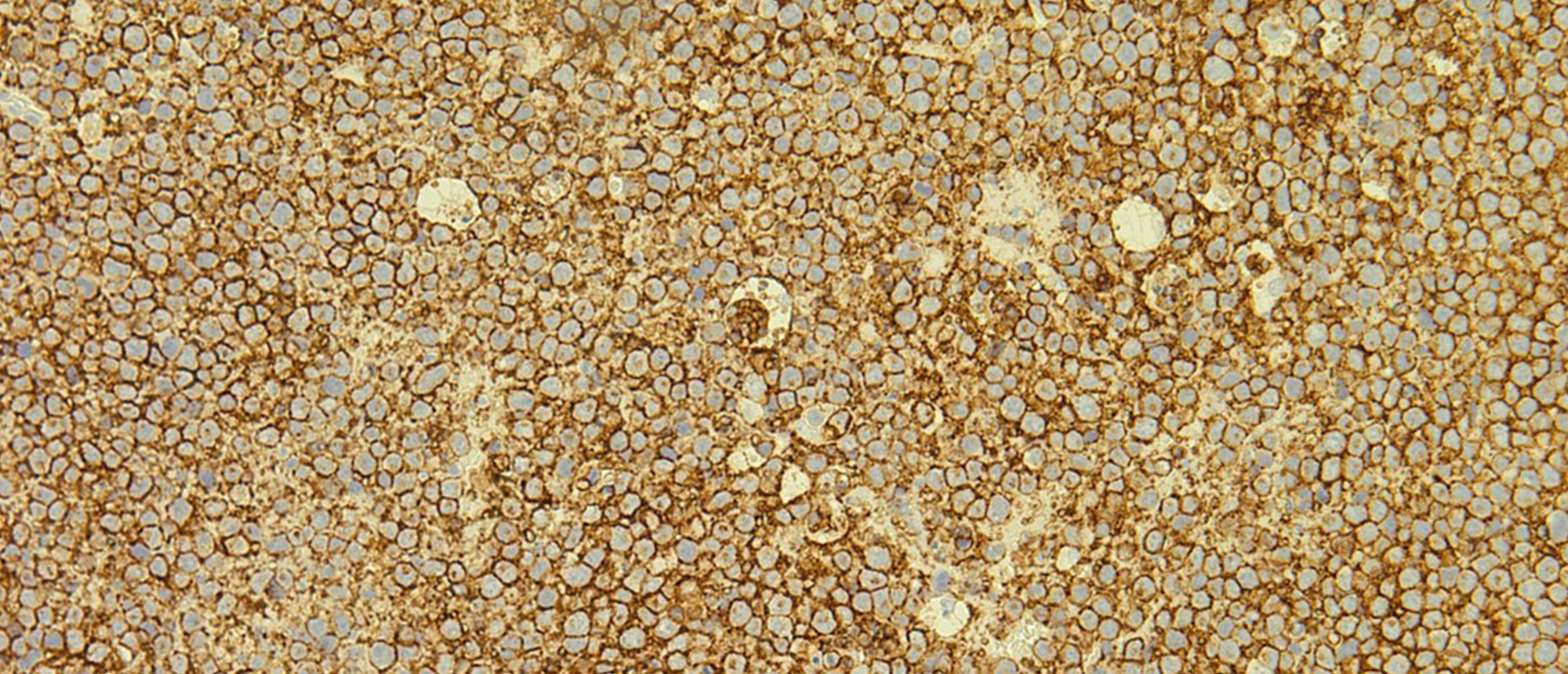 Diffuse Large B-Cell Lymphoma