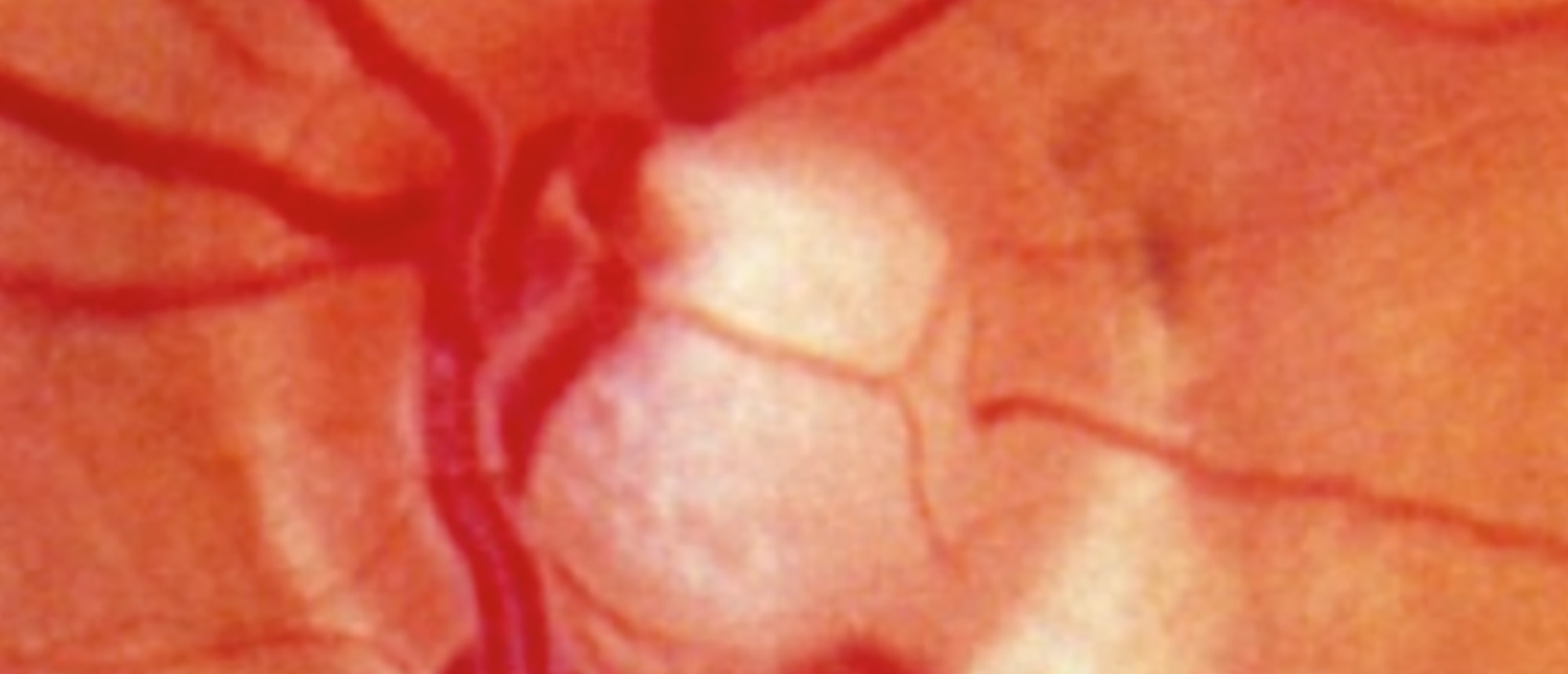 Normal Tension Glaucoma 