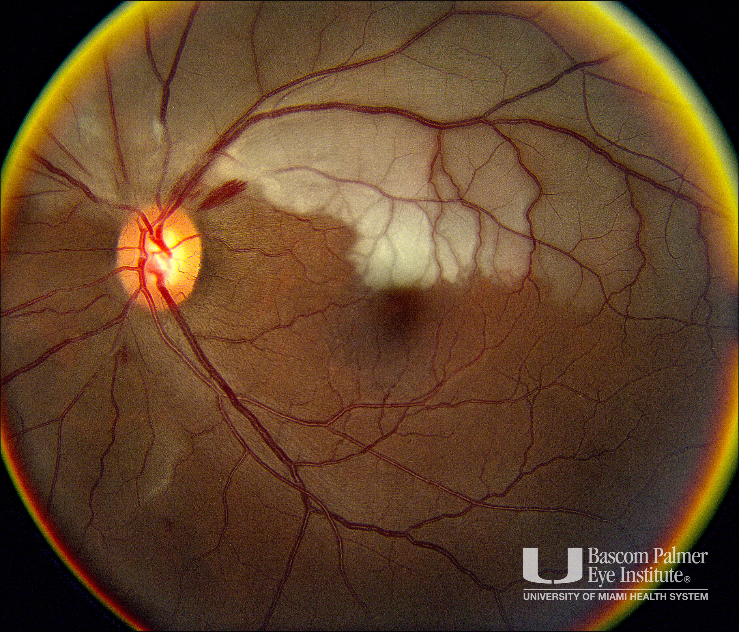 Bilateral Retinal Artery Occlusions
