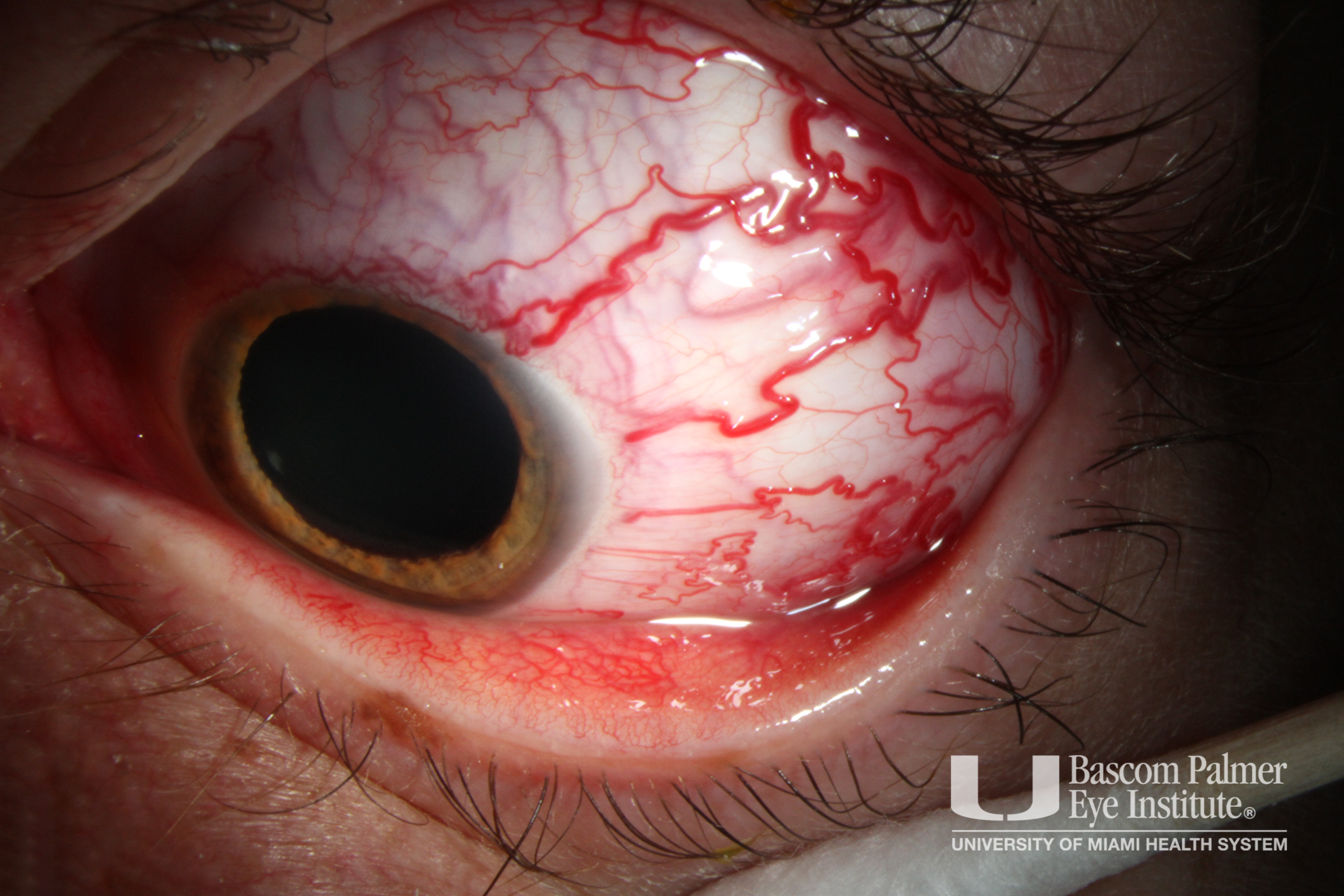 Carotid Cavernous Fistula With Ocular Ischemic Syndrome 