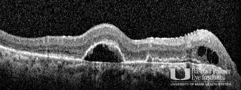 Central Serous Retinal with Choroidal Neovascularization