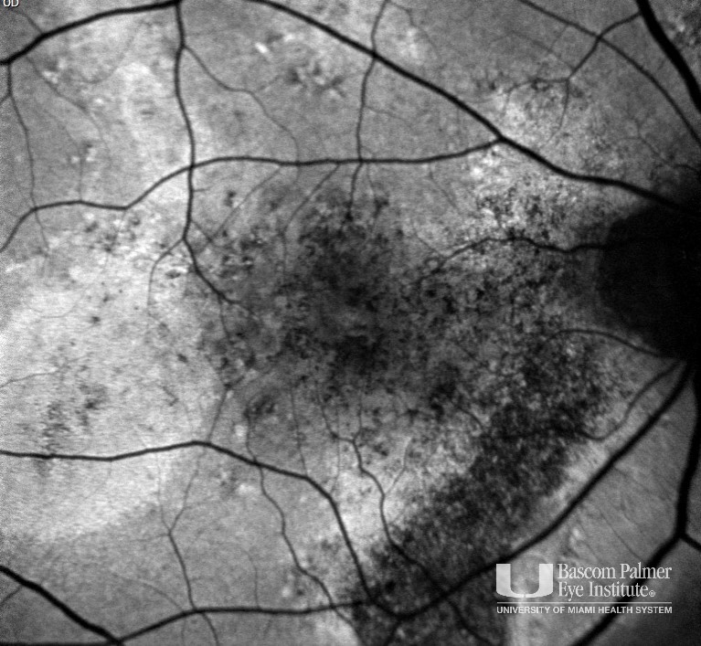 Central Serous Retinal with Choroidal Neovascularization