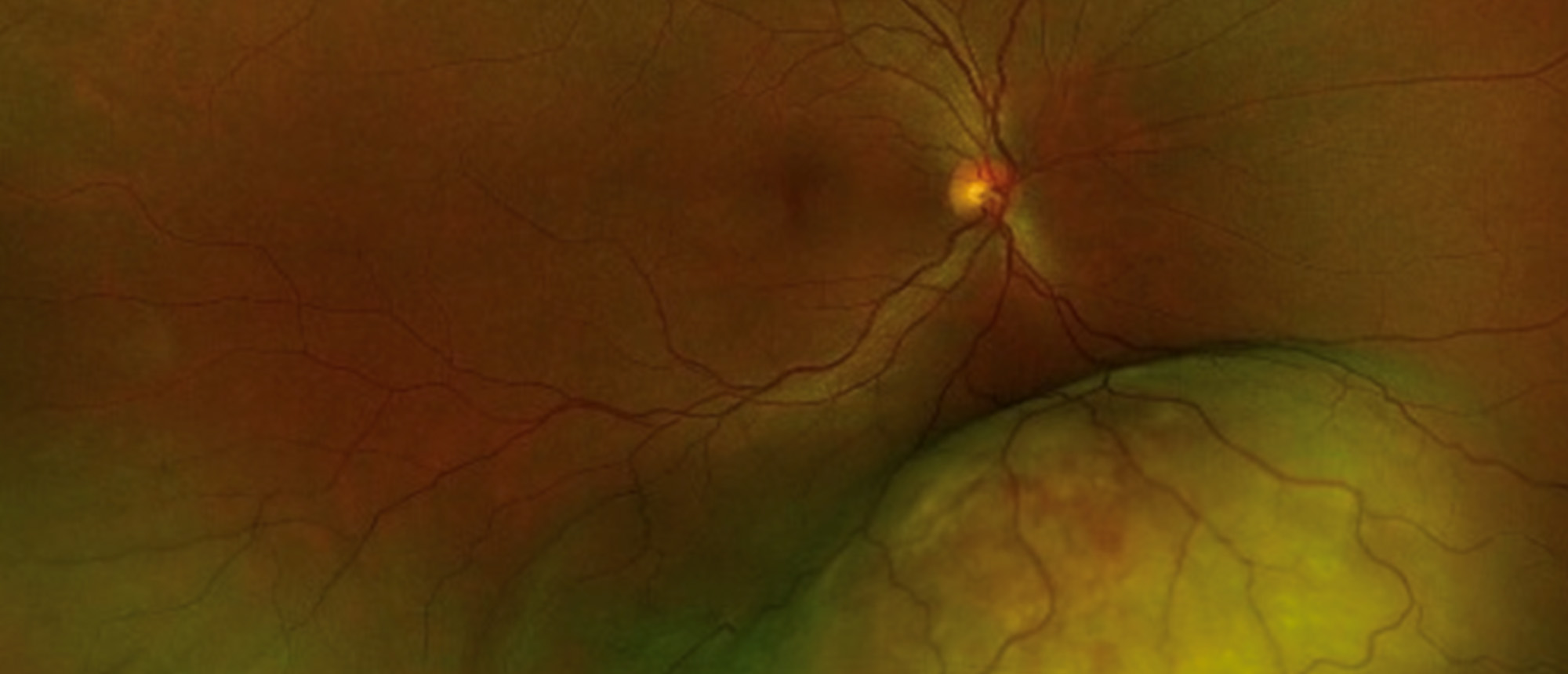Neuroendocrine Tumor Metastasis to Choroid 