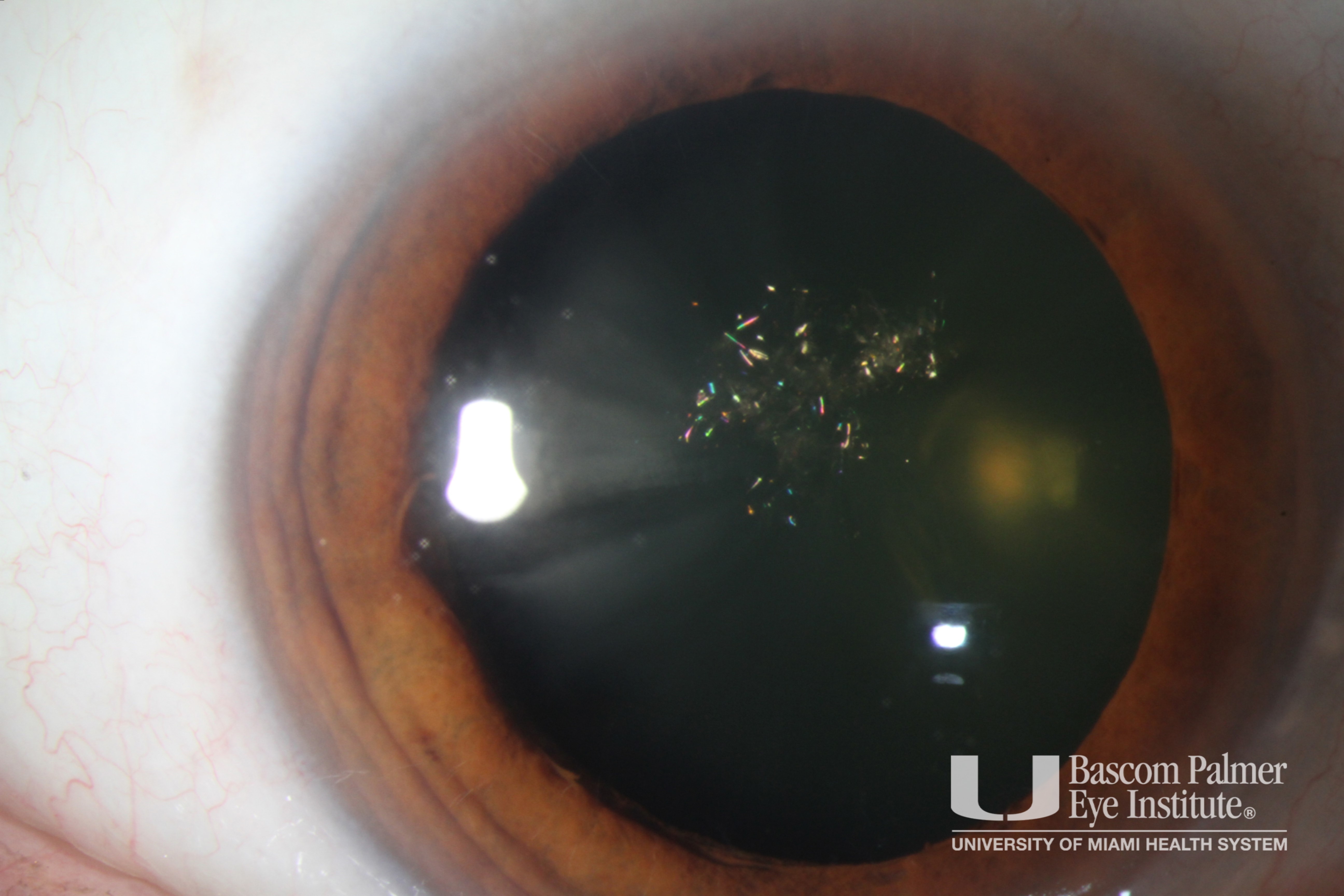 Christmas Tree Cataract in Myotonic Dystrophy