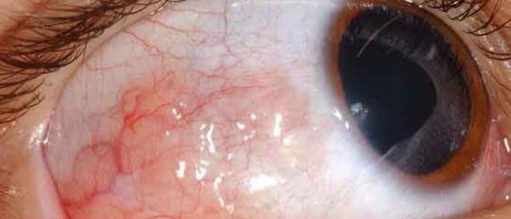 Extraocular Silicone Oil Deposition