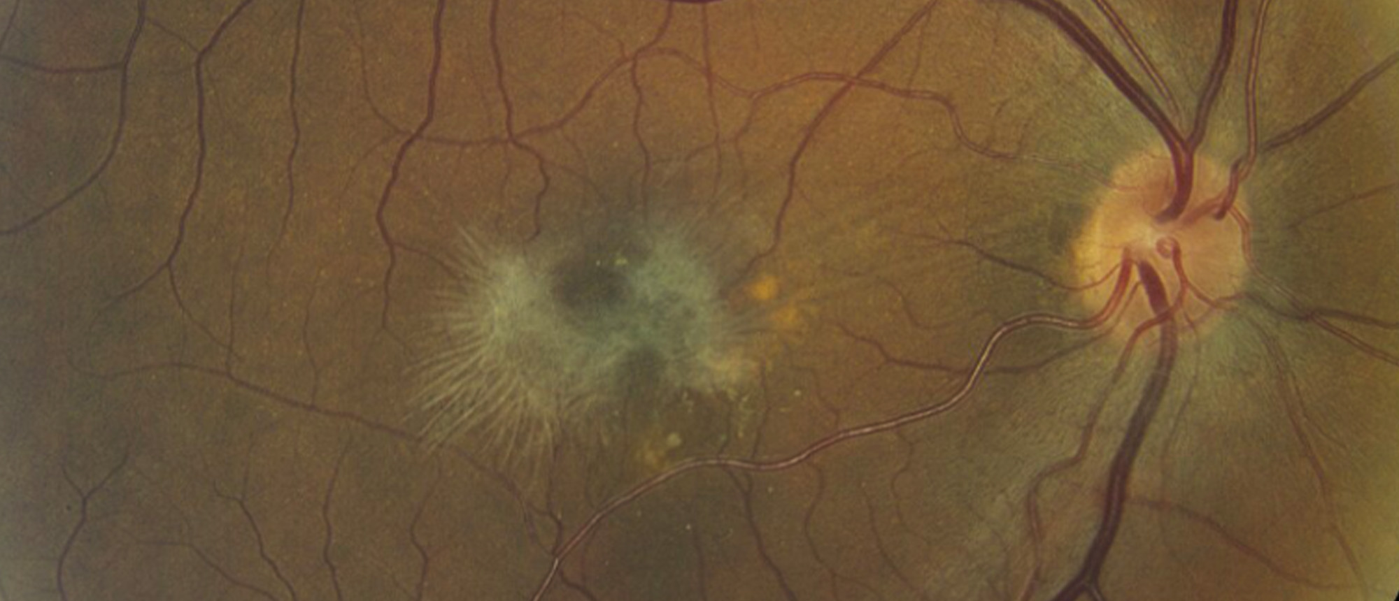 Epiretinal Membrane Secondary to Ruptured Retinal Arterial Macroaneurysm