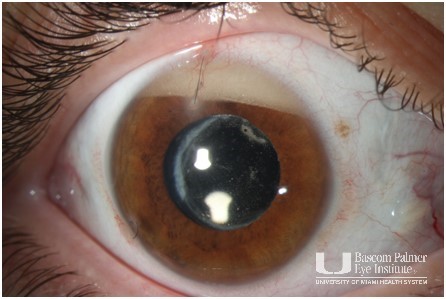 Emulsified Silicone Oil in Anterior Chamber