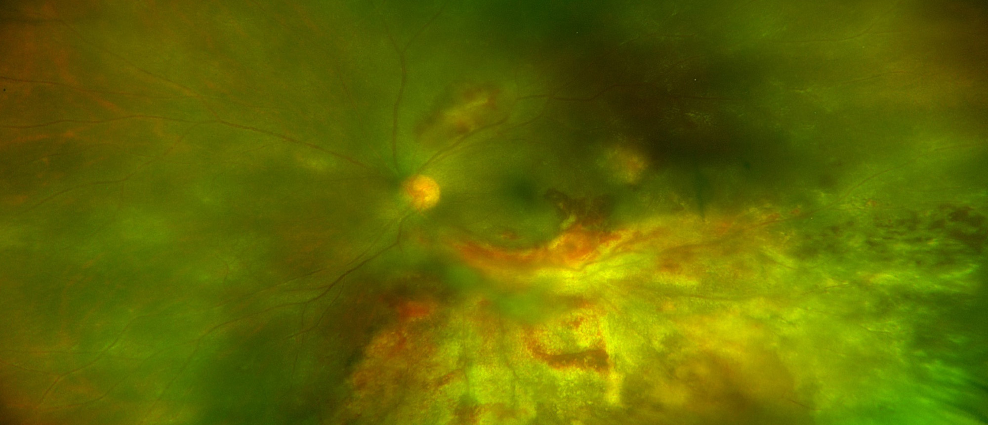 Cytomegalovirus Retinitis with Rhegmatogenous Retinal Detachment
