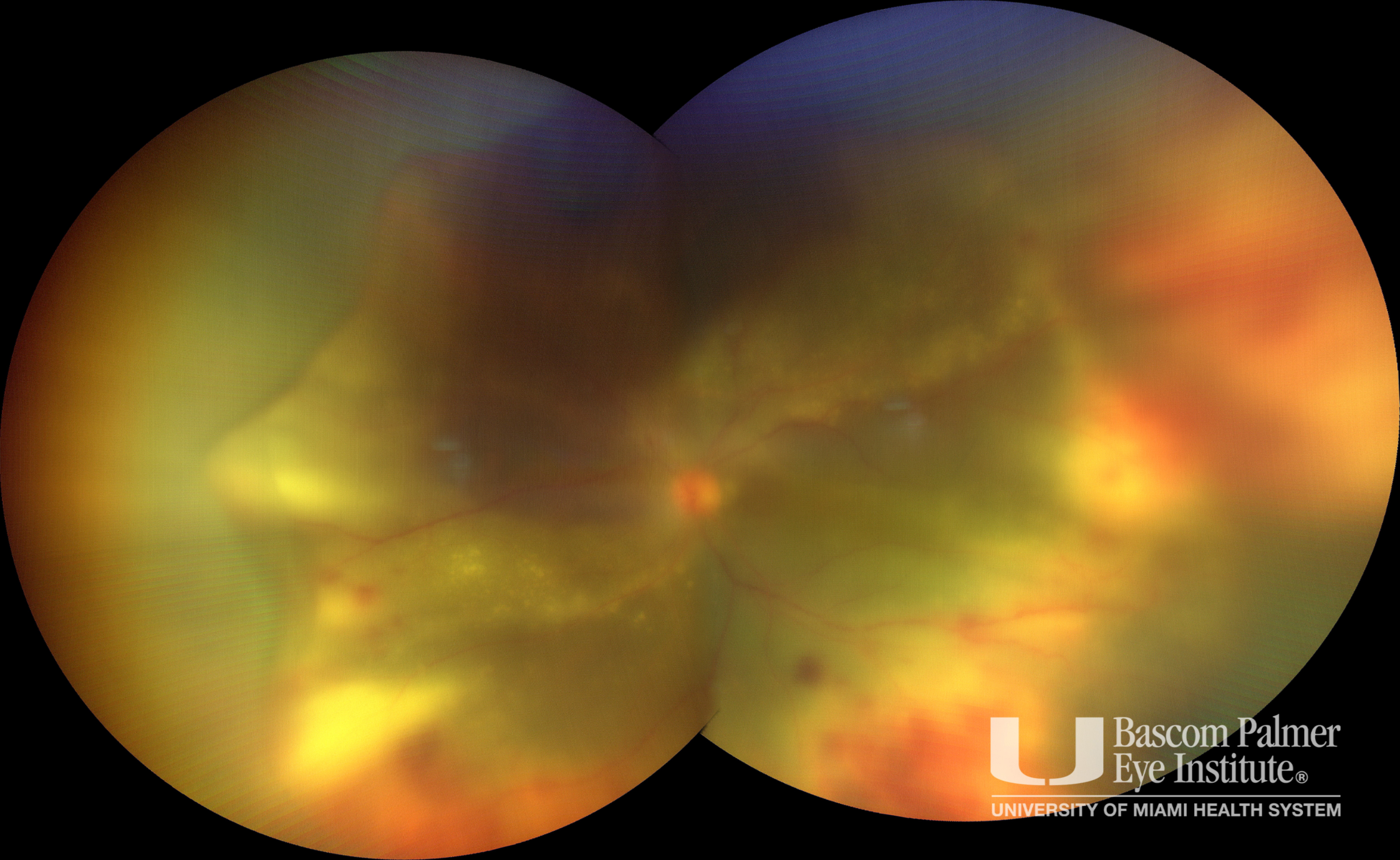 Intraocular Lymphoma Associated With Non-CNS Lymphoma Treated With Intravitreal Chemotherapy