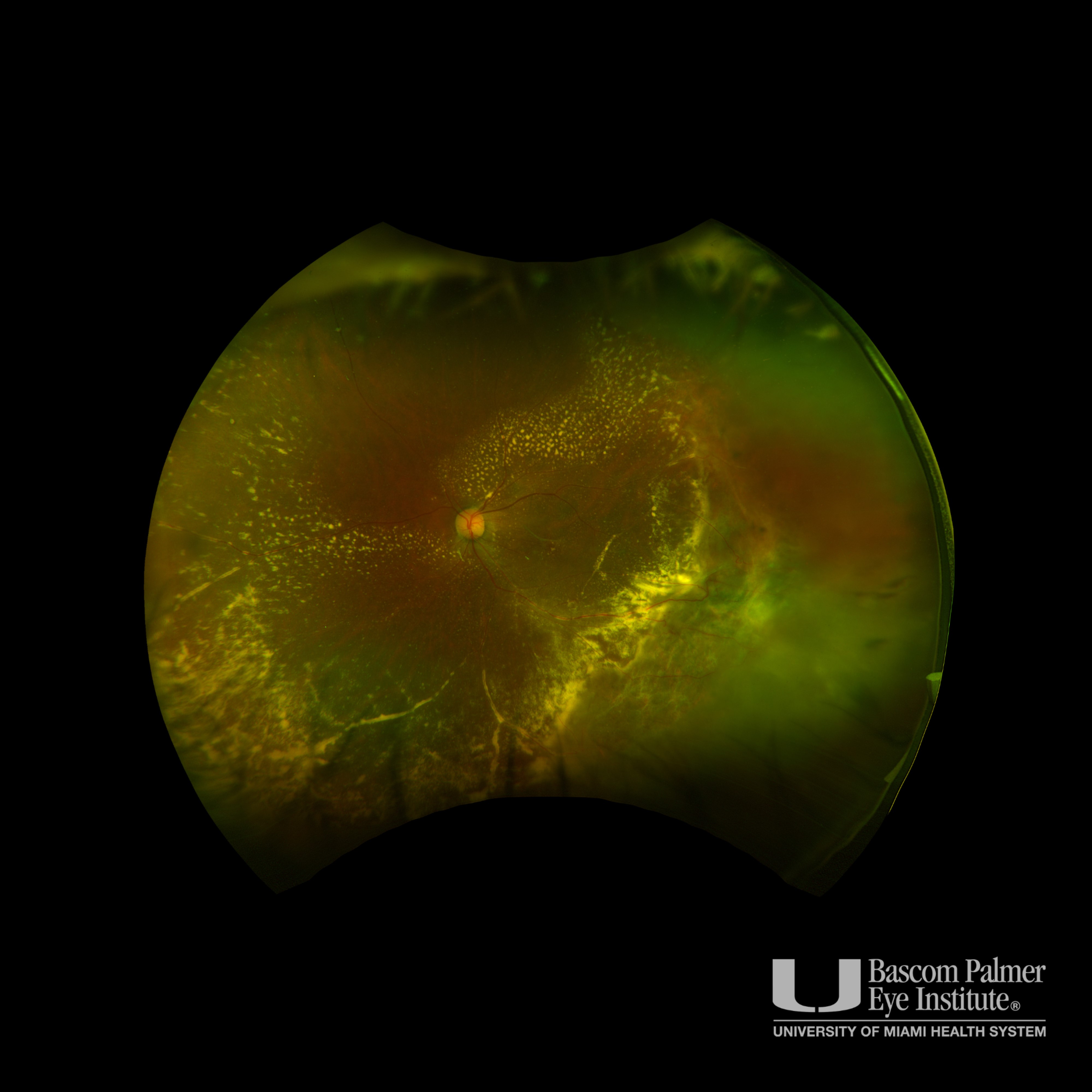 Intraocular Lymphoma Associated With Non-CNS Lymphoma Treated With Intravitreal Chemotherapy